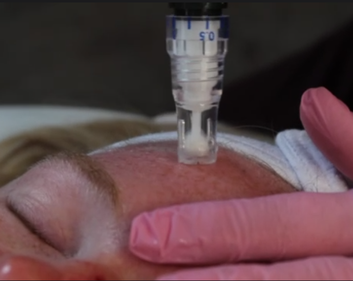 Microneedling Treatment Consultation